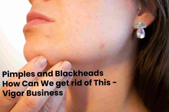 Pimples and Blackheads How Can We get rid of This - Vigor Business